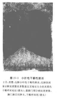 小儿结核病